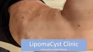 multiple lipomas causes symptoms
