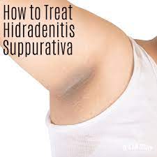 how to treat hidradenitis suppurativa