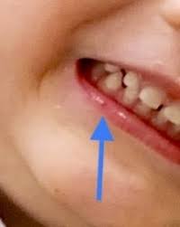 red mark on toddlers lip mumsnet