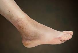 foot health causes of swollen feet and