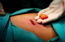 is lipoma removal surgery right for you