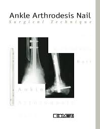 ankle arthrodesis nail biomet