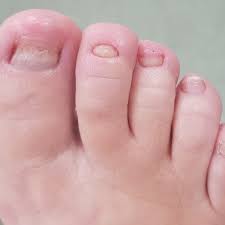 ugly fungal toenails