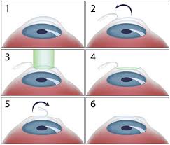 Vision changes a lot during this time, so getting lasik prematurely could make results less effective or lasting. Lasik Eye Surgery Springfield Lasik Greenfield Eye Center