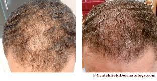 prp hair loss bald treatment