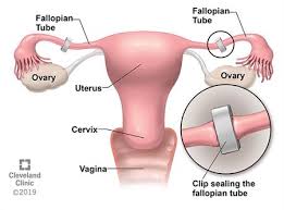 Maybe you would like to learn more about one of these? Sterilization By Laparoscopy