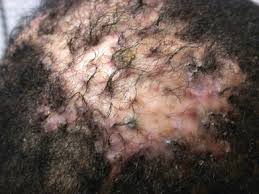 Resultado de imagen para dissecting cellulitis of the scalp