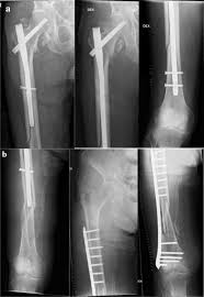 peri implant fracture a rare