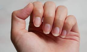 brittle nails causes treatment and