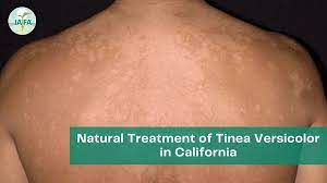 natural treatment of tinea versicolor