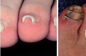 pincer toe nails you ve seen them did