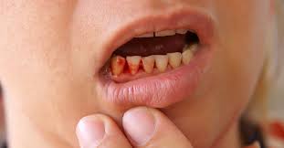 cut on the gums appearance home