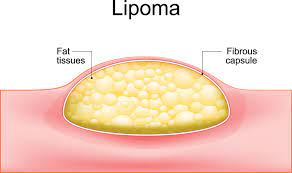 lipoma harley clinic