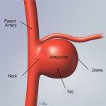 Image result for icd 10 code for ruptured berry aneurysm