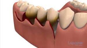 periodontal flap approach surgery