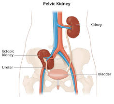 ectopic kidney niddk
