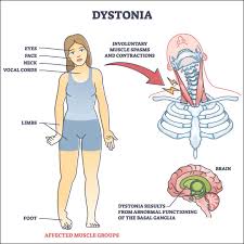 dystonia causes risk factors