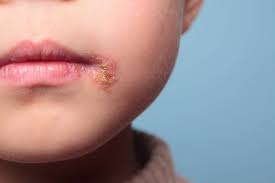 15 common skin rashes in children