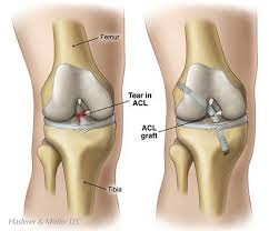knee ligament injury