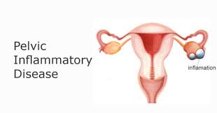 *pelvic inflammatory facts medical author: Pelvic Inflammatory Disease Pid Causes Symptoms And Treatment