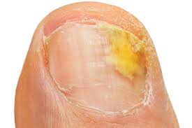 laser treatment for fungal nail