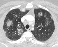 Patterns Of Lung Disease Springerlink