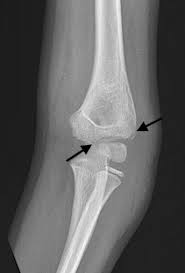Incarcerated medial epicondyle fractures are commonly associated with ulnar nerve symptoms; How To Avoid Missing A Pediatric Elbow Fracture Acep Now