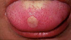 tongue ps 10 potential causes and