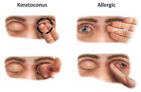 what is keratoconus eye disease