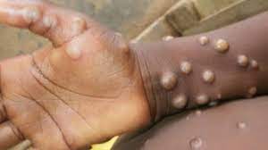 What Is Monkeypox Virus Starting To ...