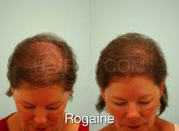 rogaine minoxidil dallas hair