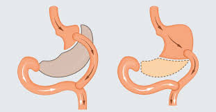 uncommon weight loss surgery best for