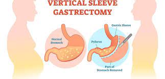sleeve gastrectomy surgery hospital india