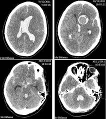Un aneurisma cerebral es una enfermedad cerebrovascular caracterizada por una dilatación de la para diagnosticar los aneurismas cerebrales se usan varias pruebas como la angiografía o el tac. Caso 61 Mujer De 48 Anos En Coma Urgencias Bidasoa