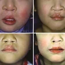 exles of bilateral cleft lip cleft