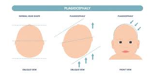 flat head syndrome facts about the
