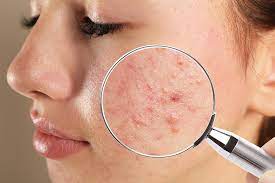 acne scar treatment cost istanbul