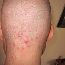 He or she may prescribe medicine, such as an antibiotic. Would Laser Hair Removal Treat My Folliculitis