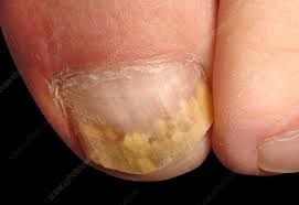 fungal nail infection stock image