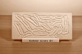 prosthetic mould keloid scars 01