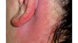 rash behind ear causes symptoms and