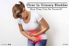 ulcer in urinary bladder how they can