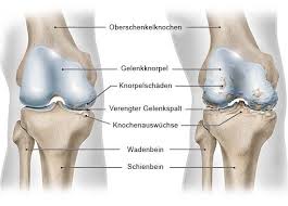 Knieschmerzen, die durch mechanische probleme im gelenk verursacht werden vs. Kniearthrose Gonarthrose Gesundheitsinformation De