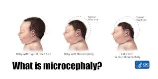 Image result for microcephaly meaning