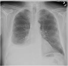 The radiographic findings of mesothelioma are nonspecific and are observed in other diseases, including metastatic carcinoma, lymphoma, and benign asbestos disease. Case Report Steroid Responsive Mesothelioma Related Pleural Effusion Sciencedirect