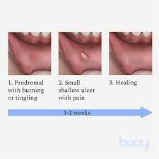 canker sores symptoms causes and