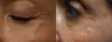 laser vein treatment cosmetic