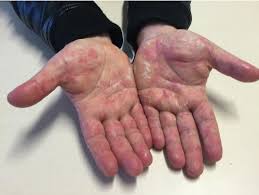 Palmar erythema definition palmar erythema involves the reddening of the palmar part of the hands, being most evident at the level of the hypothenar eminence. Palmar Erythema With Scaling Of The Skin On Both Hands 1151 Mm 863 Download Scientific Diagram
