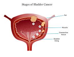 bladder cancer symptoms causes