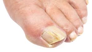 how fungal nail infections are treated